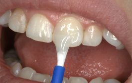 آن‌چه والدین در مورد وارنیش فلورایدتراپی فرزندان خود باید بدانند