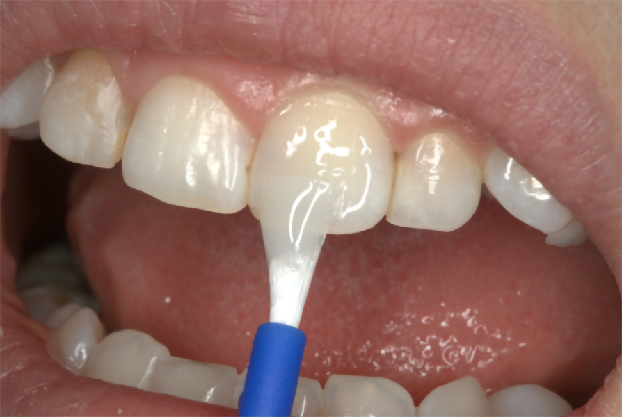 آن‌چه والدین در مورد وارنیش فلورایدتراپی فرزندان خود باید بدانند