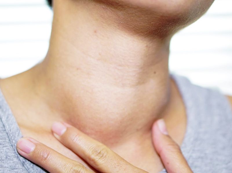 بیماری کم کاری تیروئید در بانوان و افراد ۵۵ سال شایع‌ترست